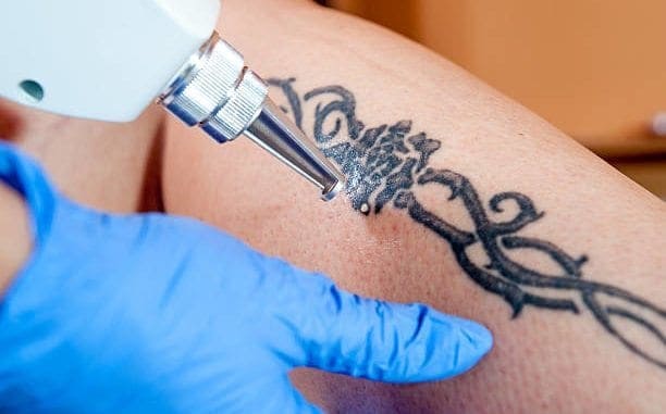 Laser Tattoo Removal Process