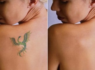 Tattoo Removal Without Laser