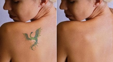 Tattoo Removal Without Laser